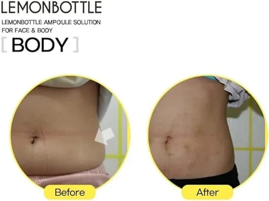 Lemon Bottle Lypolysis Solution 5 X 10ml Vials 